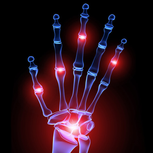 Röntgenbild einer Hand, auf dem die Gelenke rot markiert sind